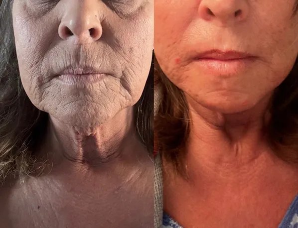 Before and After 1