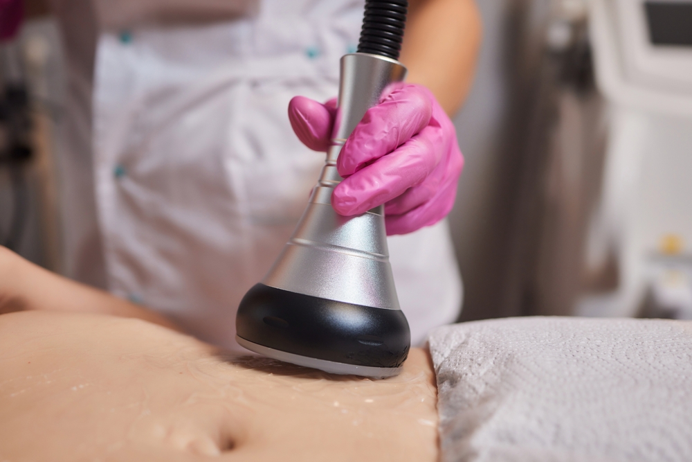 Rf skin tightening, belly